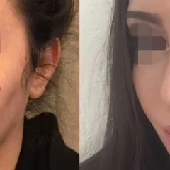 Natural nose job result for a female patient, Nisantasi clinic (4)