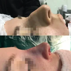Natural nose job result for a female patient, Nisantasi clinic