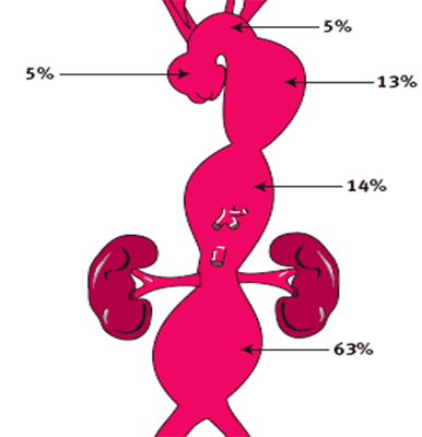 aort-anevrizması-lokalizasyon-sıklığı