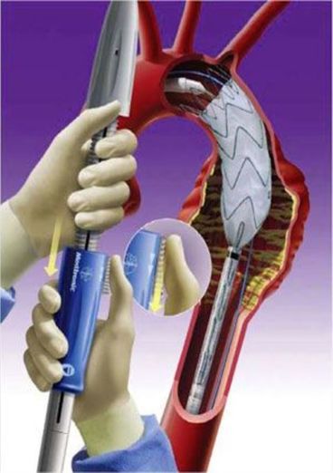 endovasküler-tedavi