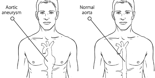 Aort anevrizmalarında tedavi