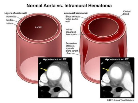 AORTİK İNTRAMURAL HEMATOM