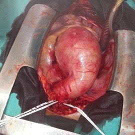 AORT ANEVRİZMASI VE HİPERTANSİYON