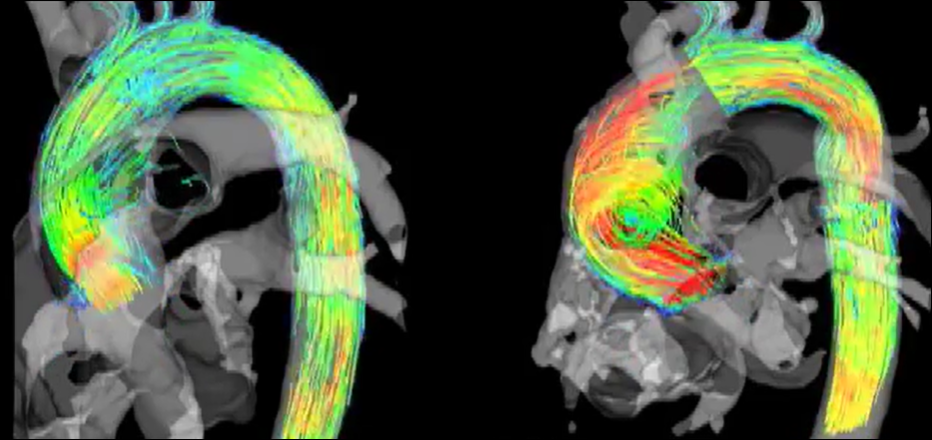 Biküspit Aort Kapak