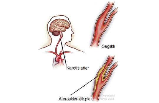 KAROTİS ARTER HASTALIĞI VE NEDENLERİ