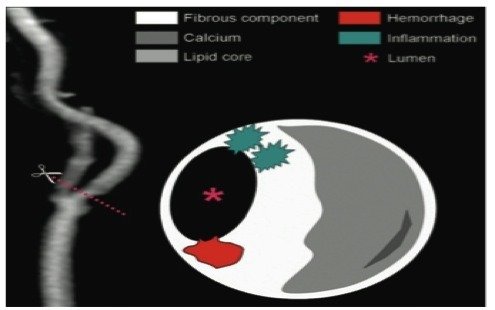 KAROTİS PLAK YAPISAL ÖZELLİKLERİ VE STABİLİZASYONU