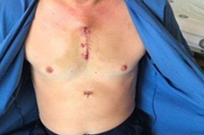 MİNİMAL İNVAZİV AORT KAPAK REPLASMANI