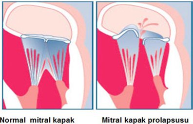 MİTRAL KAPAK PROLAPSUSU (SARKMASI)