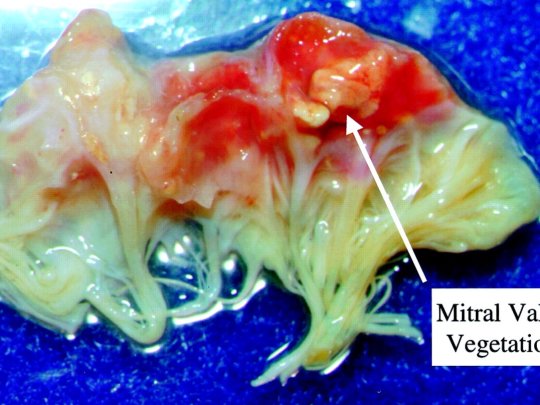 KALP KAPAKÇIK İLTİHAPLARI (ENDOKARDİTLER)
