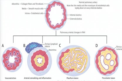 KAPAK HASTALIĞI VE PULMONER HİPERTANSİYON