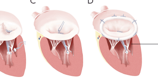 MİTRAL KAPAK TAMİRİ DEĞİŞİME GÖRE NİÇİN ÇOK AVANTAJLIDIR?