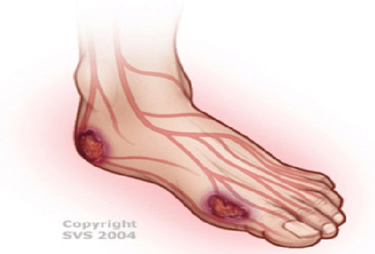 DİYABETİK AYAKTA DAMAR TUTULUMU