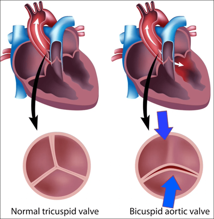Biküspit Aortik Kapak