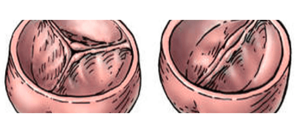 Biküspit-Aort-Kapak