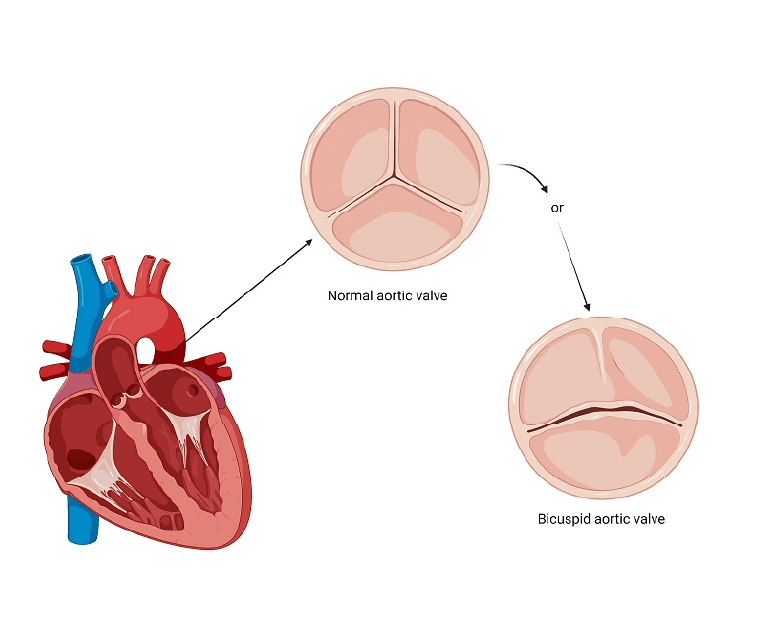 Bicuspid-Aortic-Valve1