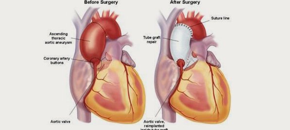 Aort-Anevri̇zmalarinda-Tedavi̇