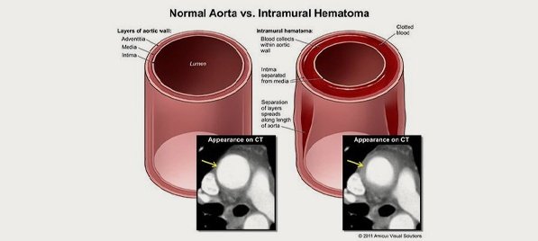 Aortik-Intramural-Hematom