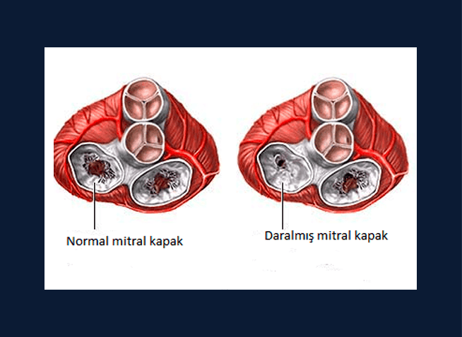 Kalp-Kapak-Hastaları