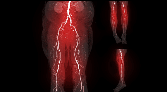 periferik-arter-hastalığı
