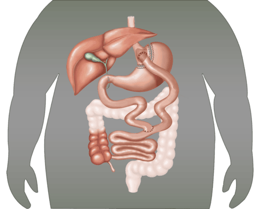 Gastric_Bypass-bütün png