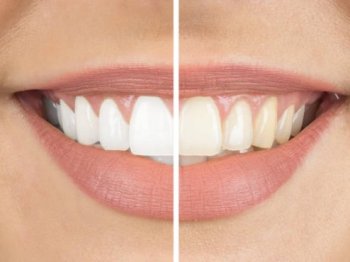 Diş Beyazlatma Sonrası Dikkat Edilmesi Gerekenler