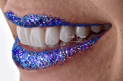 Glass Ceramic (Emax) Crown