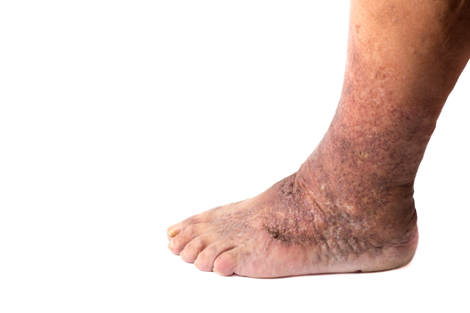 Ayak Ve Bacak Ülserleri