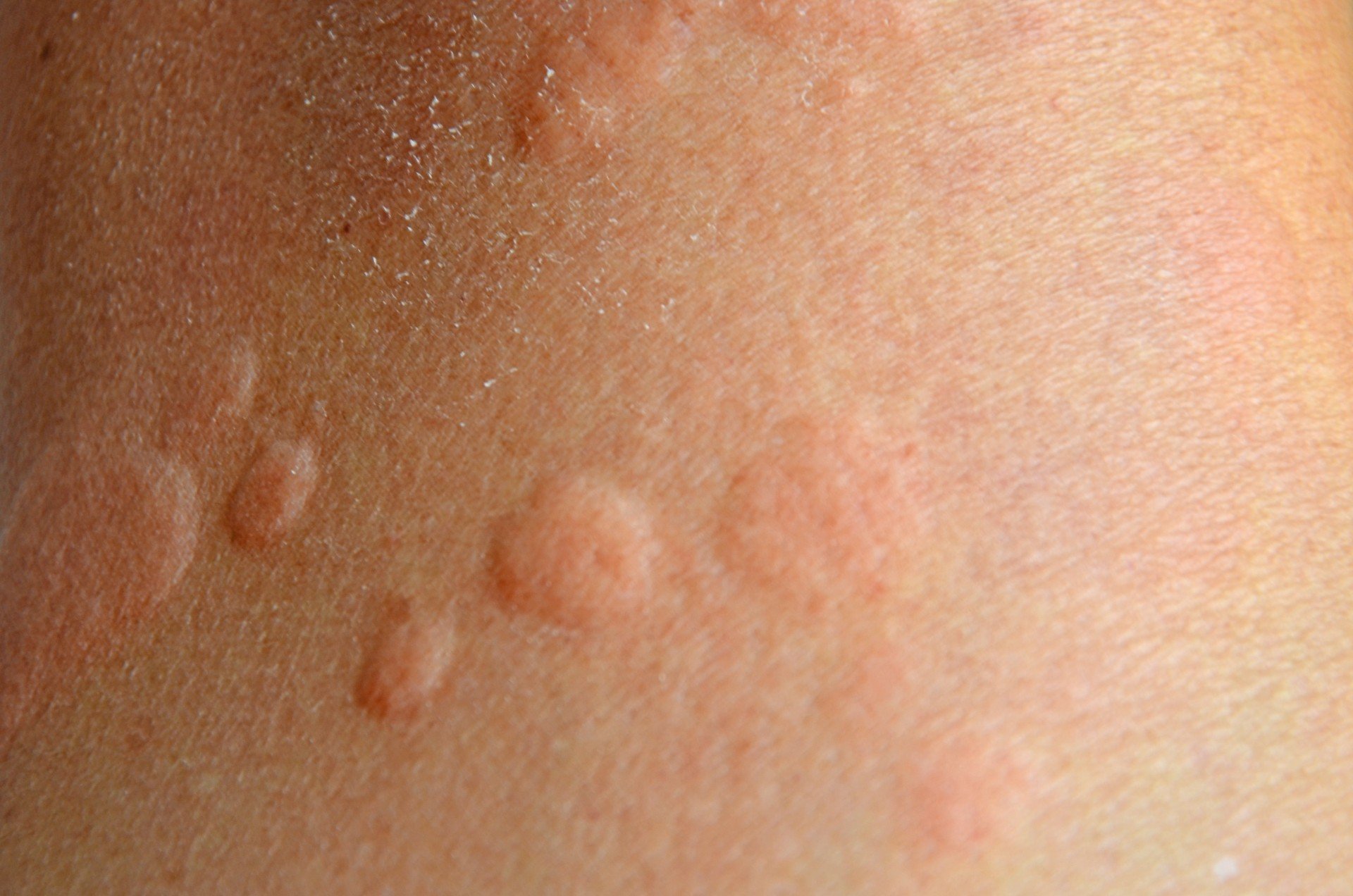 Kurdeşen Ürtiker