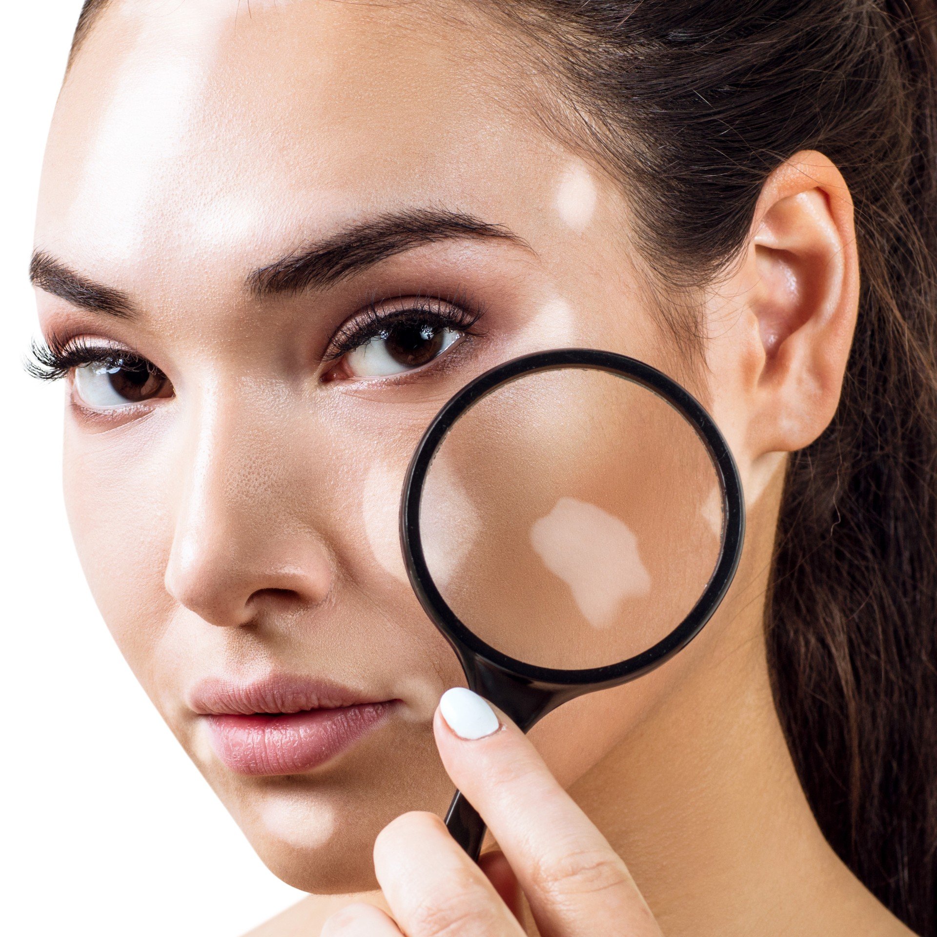 Vitiligo Tedavisi Antalya