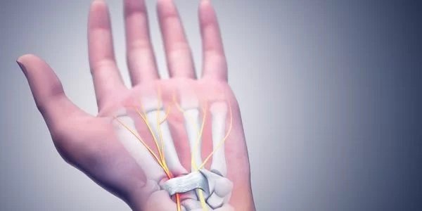 karpal tünel sendromu-1