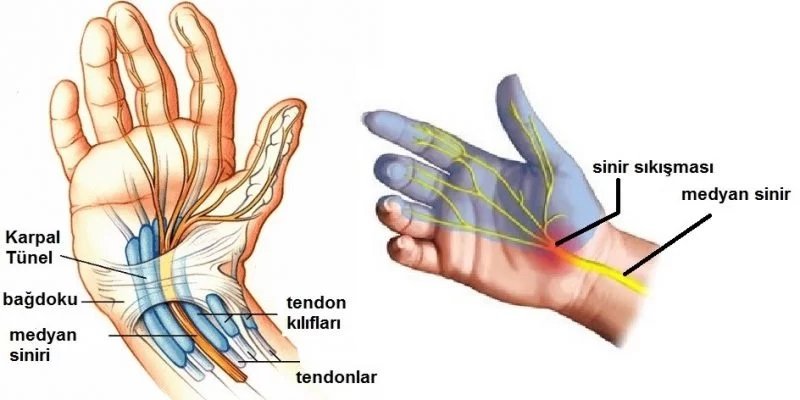 karpal tünel sendromu-2