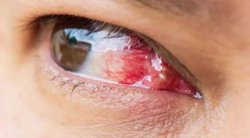 PTERJIUM HASTALIĞINDAN KORUNMA