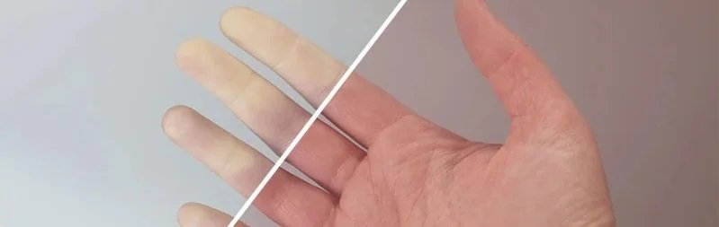 raynaud fenomeni-3