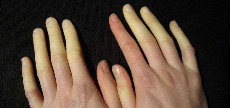 raynaud fenomeni-1