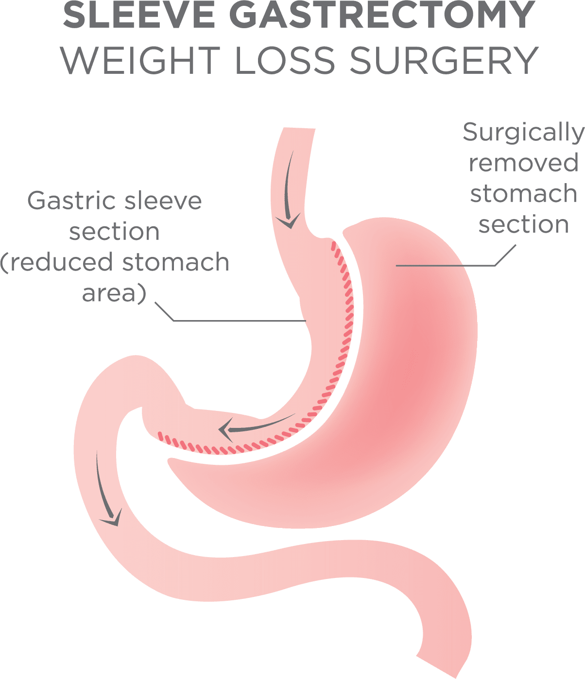 Gastric Sleeve Surgery in Turkey Price-All Inclusive