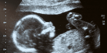 Doğum Öncesi Nedenlere Bağlı İşitme Kaybı