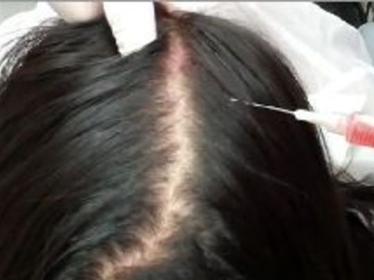 Saç dökülmesi ve PRP tedavisi