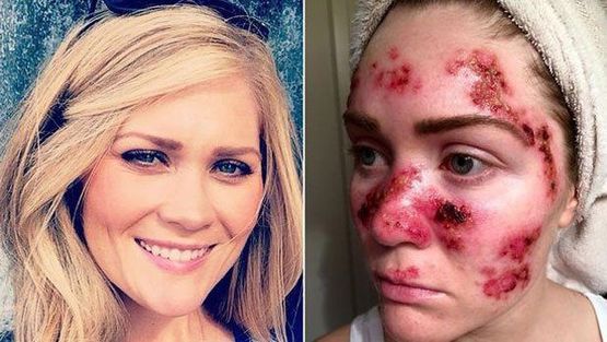 Solaryum ve Cilt Kanseri İlişkisi: Bir Annenin Hikayesi