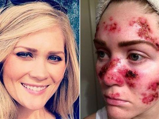 Solaryum ve Cilt Kanseri İlişkisi: Bir Annenin Hikayesi