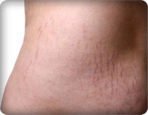 Gebelik Çatlakları