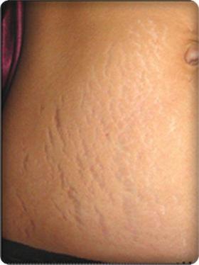 Gebelik Çatlakları