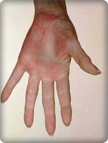 Gebelikte Damarsal Değişimler