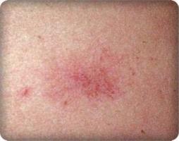 YÜZ BOYUN ve KOLLARDA KIZARIKLIK