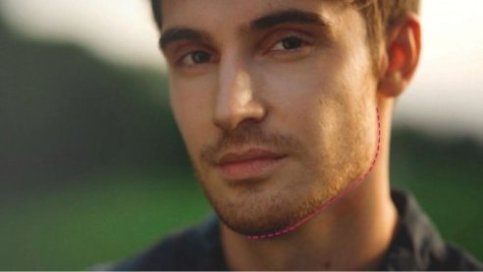 antalyada jawline dolgu erkek