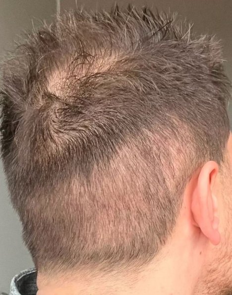 saç ekimi aşırı hasat overharvesting