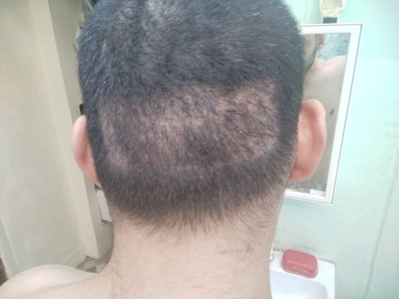 saç ekiminde donörden uygunsuz alım