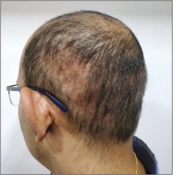 saç ekiminde skar oluşumu