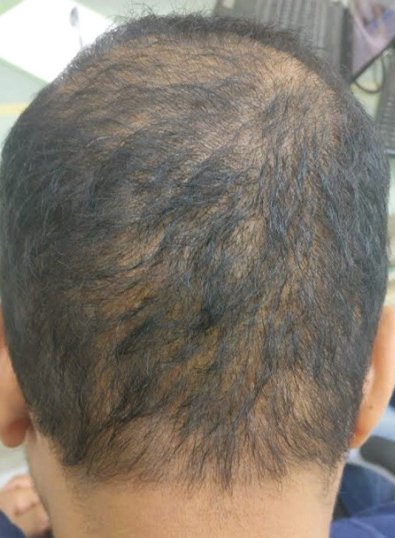 saç ekiminde overharvesting