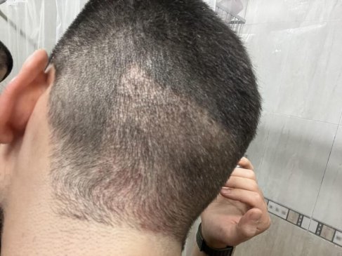 saç ekiminde donörden aşırı alım