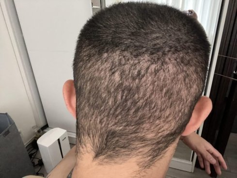 saç ekiminde donör hasarı